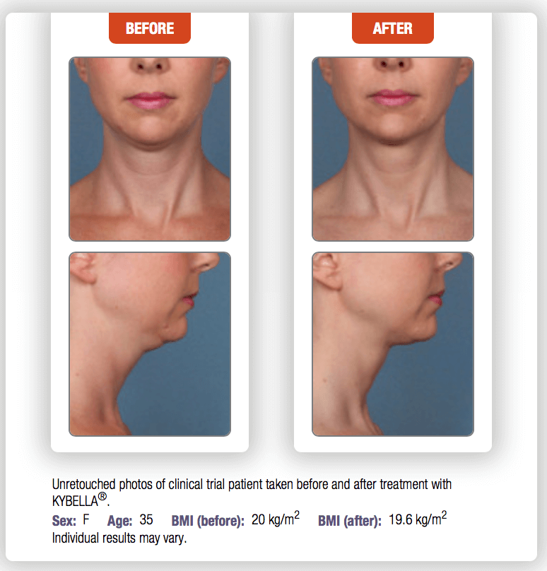 kybella-before-and-after