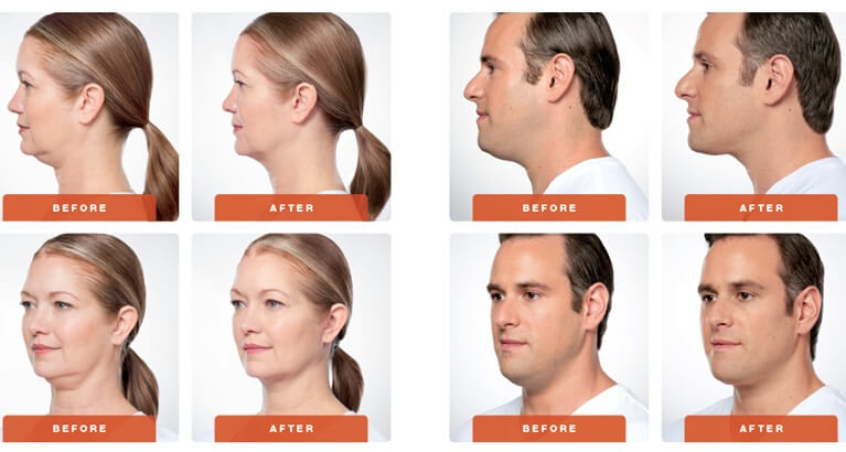 kybella-before-after