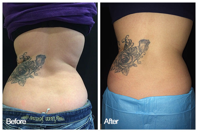 coolsculpting-before-after