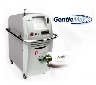 gentlemax candela laser hair removal