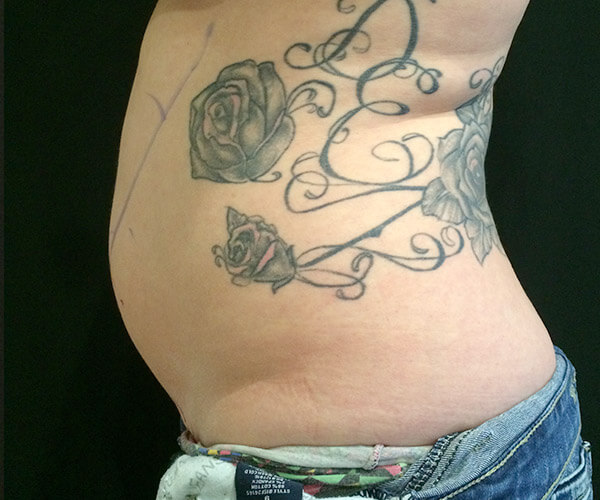1-coolsculpting-side-before