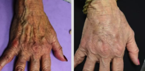 Hand Rejuvenation Before and After Smith Surgery Las Vegas Chic la Vie Med Spa