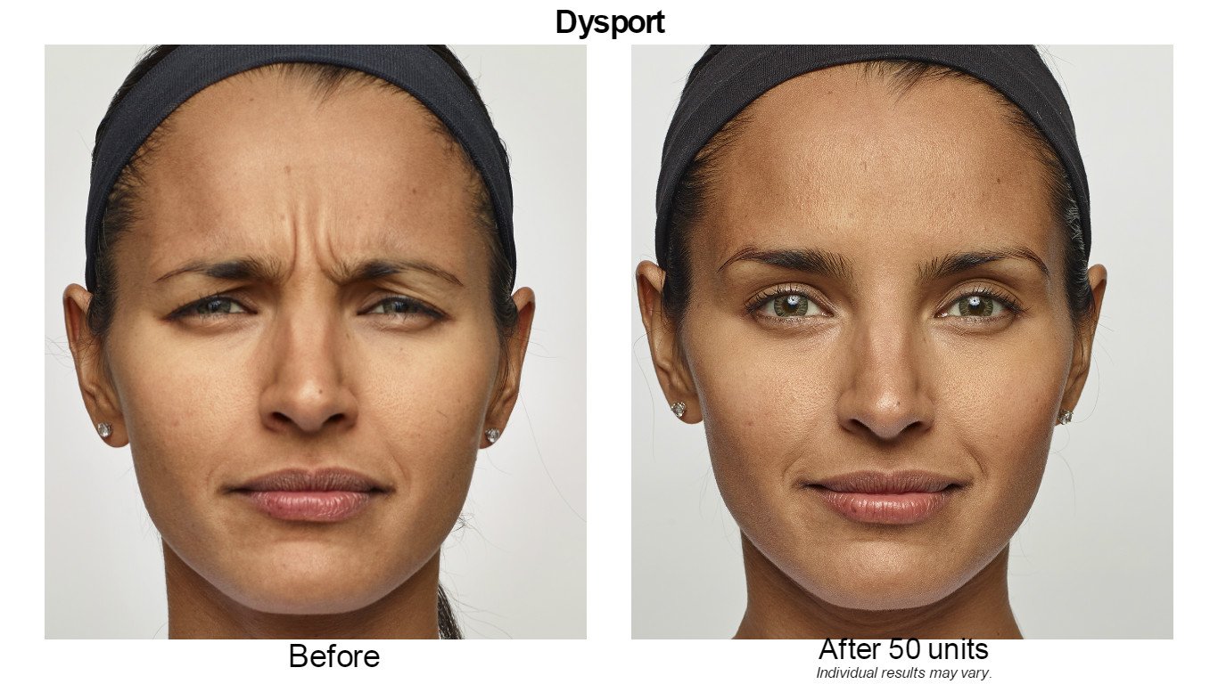 Dysport Before and After