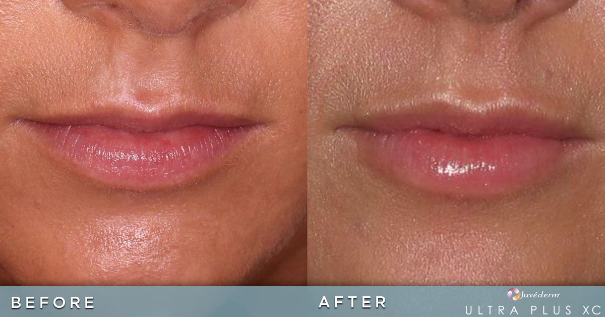 Juvederm ultra plus lips