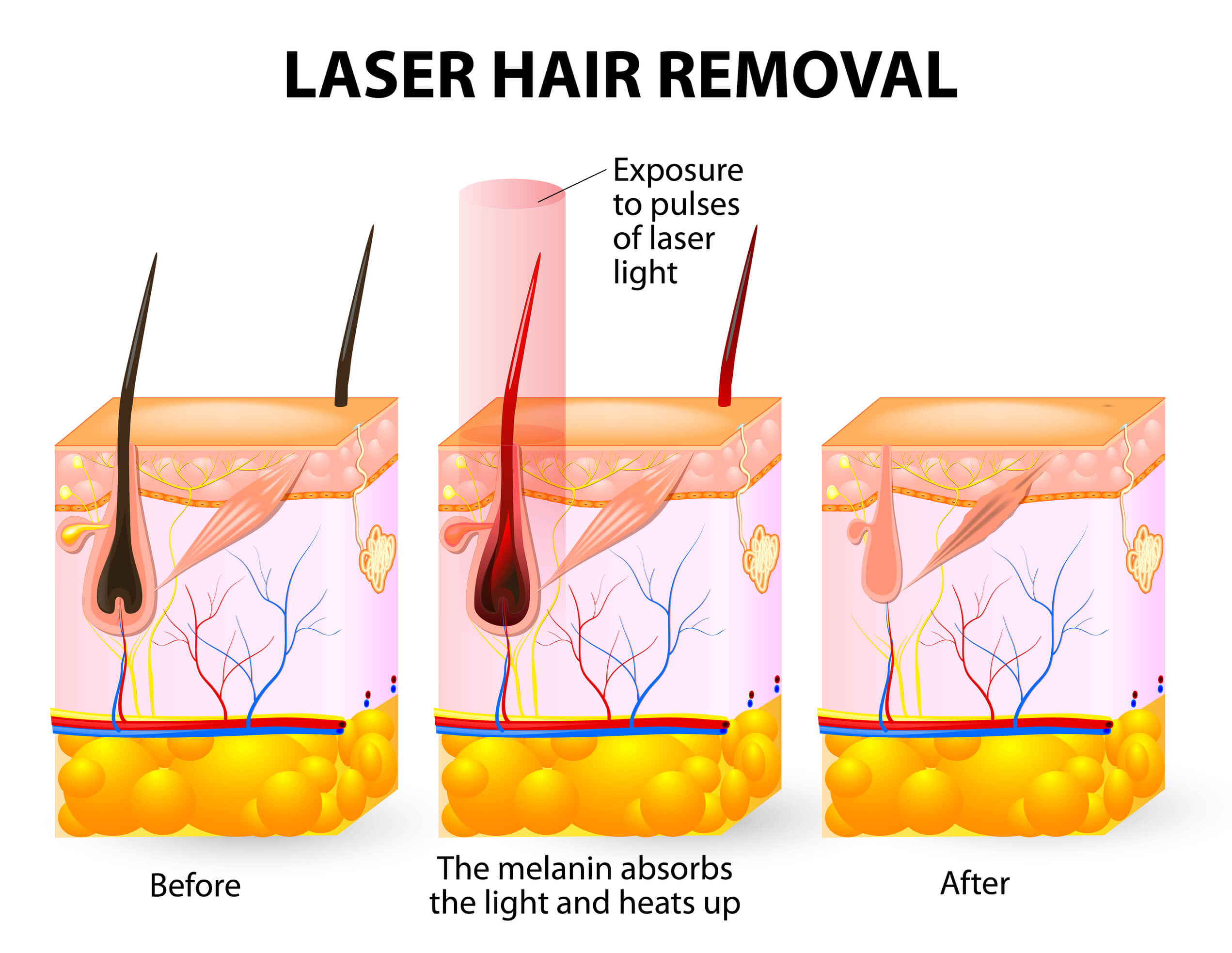 How Much Does Laser Hair Removal Cost Chic la Vie Med Spa