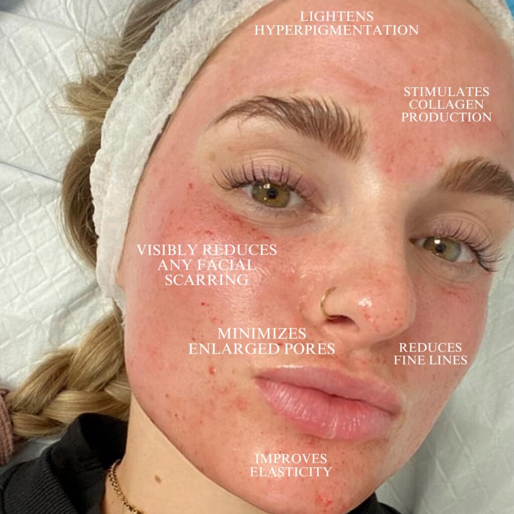 Woman with a headband shows red, irritated skin on her face; text highlights Morpheus8 face benefits like lightening pigmentation and reducing pores, scars, and fine lines for facial rejuvenation.